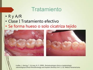 • R y A/R
• Clase I Tratamiento efectivo
• Se forma hueso o solo cicatriza tejido
Lindhe, J., Karring, T., & Lang, N. P. (2009). Periodontologia clinica e implantologia
odontologica/Clinical Periodontology and Implant Dentistry (Vol. 1). Ed. Médica Panamericana.
Tratamiento
 