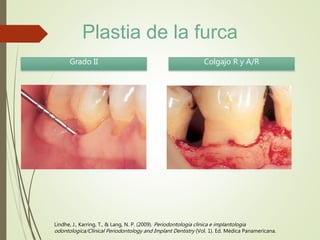 Lindhe, J., Karring, T., & Lang, N. P. (2009). Periodontologia clinica e implantologia
odontologica/Clinical Periodontology and Implant Dentistry (Vol. 1). Ed. Médica Panamericana.
Grado II Colgajo R y A/R
Plastia de la furca
 