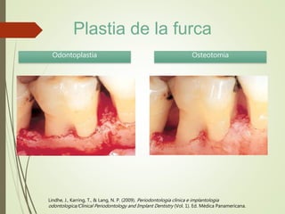 Lindhe, J., Karring, T., & Lang, N. P. (2009). Periodontologia clinica e implantologia
odontologica/Clinical Periodontology and Implant Dentistry (Vol. 1). Ed. Médica Panamericana.
Odontoplastia Osteotomia
Plastia de la furca
 
