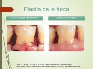Lindhe, J., Karring, T., & Lang, N. P. (2009). Periodontologia clinica e implantologia
odontologica/Clinical Periodontology and Implant Dentistry (Vol. 1). Ed. Médica Panamericana.
Sutura colgajo Apicalmente Cicatrización “papila”
Plastia de la furca
 