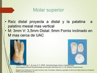 • Raíz distal proyecta a distal y la palatina a
palatino mesial mas vertical
• M: 3mm V: 3,5mm Distal: 5mm Fornix inclinado en
M mas cerca de UAC
Lindhe, J., Karring, T., & Lang, N. P. (2009). Periodontologia clinica e implantologia
odontologica/Clinical Periodontology and Implant Dentistry (Vol. 1). Ed. Médica Panamericana.
Diagnosis and Treatment of Furcation-Involved Teeth, First Edition. Edited by Luigi Nibali. © 2018 John Wiley & Sons Ltd. Published
2018 by John Wiley & Sons Ltd.
Molar superior
 