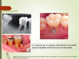 Tunelización
La creación de un espacio interradicular accesible
para el cepillado entre las furcas involucradas
Diagnosis and Treatment of Furcation-Involved Teeth, First Edition. Edited by Luigi Nibali. © 2018 John Wiley & Sons Ltd. Published
2018 by John Wiley & Sons Ltd.
 