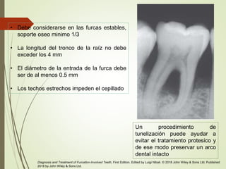 • Debe considerarse en las furcas estables,
soporte oseo minimo 1/3
• La longitud del tronco de la raíz no debe
exceder los 4 mm
• El diámetro de la entrada de la furca debe
ser de al menos 0.5 mm
• Los techos estrechos impeden el cepillado
Un procedimiento de
tunelización puede ayudar a
evitar el tratamiento protesico y
de ese modo preservar un arco
dental intacto
Diagnosis and Treatment of Furcation-Involved Teeth, First Edition. Edited by Luigi Nibali. © 2018 John Wiley & Sons Ltd. Published
2018 by John Wiley & Sons Ltd.
 