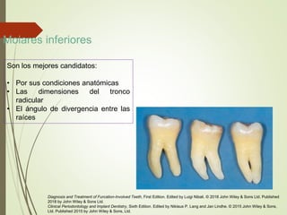 Son los mejores candidatos:
• Por sus condiciones anatómicas
• Las dimensiones del tronco
radicular
• El ángulo de divergencia entre las
raíces
Diagnosis and Treatment of Furcation-Involved Teeth, First Edition. Edited by Luigi Nibali. © 2018 John Wiley & Sons Ltd. Published
2018 by John Wiley & Sons Ltd.
Clinical Periodontology and Implant Dentistry, Sixth Edition. Edited by Niklaus P. Lang and Jan Lindhe. © 2015 John Wiley & Sons,
Ltd. Published 2015 by John Wiley & Sons, Ltd.
Molares inferiores
 