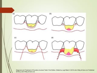 Diagnosis and Treatment of Furcation-Involved Teeth, First Edition. Edited by Luigi Nibali. © 2018 John Wiley & Sons Ltd. Published
2018 by John Wiley & Sons Ltd.
 