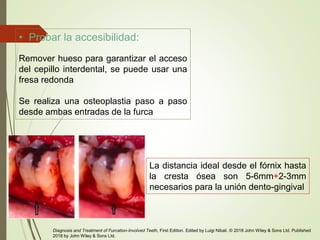 • Probar la accesibilidad:
Remover hueso para garantizar el acceso
del cepillo interdental, se puede usar una
fresa redonda
Se realiza una osteoplastia paso a paso
desde ambas entradas de la furca
La distancia ideal desde el fórnix hasta
la cresta ósea son 5-6mm+2-3mm
necesarios para la unión dento-gingival
Diagnosis and Treatment of Furcation-Involved Teeth, First Edition. Edited by Luigi Nibali. © 2018 John Wiley & Sons Ltd. Published
2018 by John Wiley & Sons Ltd.
 