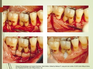 Clinical Periodontology and Implant Dentistry, Sixth Edition. Edited by Niklaus P. Lang and Jan Lindhe. © 2015 John Wiley & Sons,
Ltd. Published 2015 by John Wiley & Sons, Ltd.
 