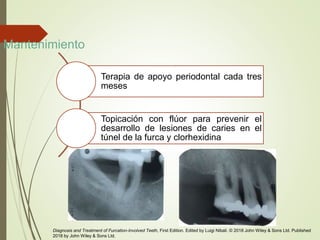 Mantenimiento
Terapia de apoyo periodontal cada tres
meses
Topicación con flúor para prevenir el
desarrollo de lesiones de caries en el
túnel de la furca y clorhexidina
Diagnosis and Treatment of Furcation-Involved Teeth, First Edition. Edited by Luigi Nibali. © 2018 John Wiley & Sons Ltd. Published
2018 by John Wiley & Sons Ltd.
 