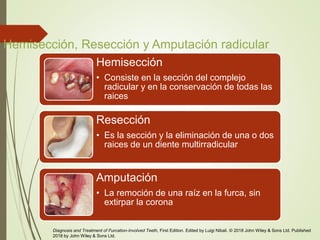 Hemisección, Resección y Amputación radicular
Hemisección
• Consiste en la sección del complejo
radicular y en la conservación de todas las
raices
Resección
• Es la sección y la eliminación de una o dos
raices de un diente multirradicular
Amputación
• La remoción de una raíz en la furca, sin
extirpar la corona
Diagnosis and Treatment of Furcation-Involved Teeth, First Edition. Edited by Luigi Nibali. © 2018 John Wiley & Sons Ltd. Published
2018 by John Wiley & Sons Ltd.
 