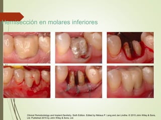 Hemisección en molares inferiores
Clinical Periodontology and Implant Dentistry, Sixth Edition. Edited by Niklaus P. Lang and Jan Lindhe. © 2015 John Wiley & Sons,
Ltd. Published 2015 by John Wiley & Sons, Ltd.
 