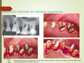 Resección radicular en molares superiores
Clinical Periodontology and Implant Dentistry, Sixth Edition. Edited by Niklaus P. Lang and Jan Lindhe. © 2015 John Wiley & Sons,
Ltd. Published 2015 by John Wiley & Sons, Ltd.
 