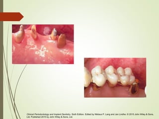 Clinical Periodontology and Implant Dentistry, Sixth Edition. Edited by Niklaus P. Lang and Jan Lindhe. © 2015 John Wiley & Sons,
Ltd. Published 2015 by John Wiley & Sons, Ltd.
 