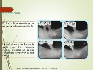 Amputación
La indicación más frecuente
suele ser los primeros
molares inferiores en los que
se requiere conservar su raíz
mesial
En los molares superiores, se
conserva raíz mesiovestibular
Quispe L. Radicectomia. Rev Actualización Clinica. 2012; 21: 1095-1099
 