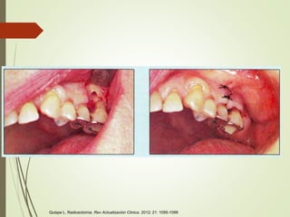 Quispe L. Radicectomia. Rev Actualización Clinica. 2012; 21: 1095-1099
 
