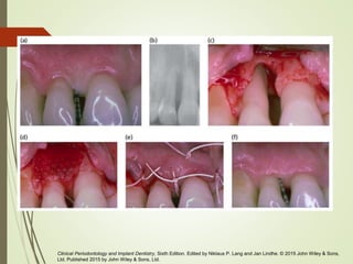 Clinical Periodontology and Implant Dentistry, Sixth Edition. Edited by Niklaus P. Lang and Jan Lindhe. © 2015 John Wiley & Sons,
Ltd. Published 2015 by John Wiley & Sons, Ltd.
 