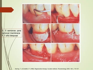 E. 5 semanas para
remover membrana
F. 1 año despues
Karring, T., & Cortellini, P. (1999). Regenerative therapy: furcation defects. Periodontology 2000, 19(1), 115-137.
 