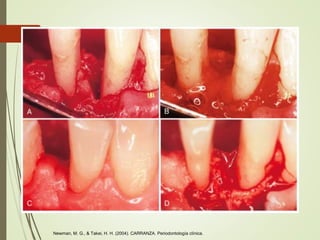 Newman, M. G., & Takei, H. H. (2004). CARRANZA. Periodontología clínica.
 