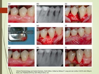 Clinical Periodontology and Implant Dentistry, Sixth Edition. Edited by Niklaus P. Lang and Jan Lindhe. © 2015 John Wiley &
Sons, Ltd. Published 2015 by John Wiley & Sons, Ltd.
 