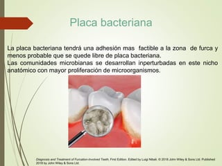 La placa bacteriana tendrá una adhesión mas factible a la zona de furca y
menos probable que se quede libre de placa bacteriana.
Las comunidades microbianas se desarrollan inperturbadas en este nicho
anatómico con mayor proliferación de microorganismos.
Diagnosis and Treatment of Furcation-Involved Teeth, First Edition. Edited by Luigi Nibali. © 2018 John Wiley & Sons Ltd. Published
2018 by John Wiley & Sons Ltd.
Placa bacteriana
 