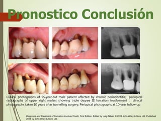 Pronostico Conclusión
Diagnosis and Treatment of Furcation-Involved Teeth, First Edition. Edited by Luigi Nibali. © 2018 John Wiley & Sons Ltd. Published
2018 by John Wiley & Sons Ltd.
Clinical photographs of 55‐year‐old male patient affected by chronic periodontitis; periapical
radiographs of upper right molars showing triple degree III furcation involvement ; clinical
photographs taken 10 years after tunnelling surgery; Periapical photographs at 10‐year follow‐up
 