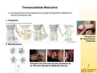 Transexualidade Masculina:
     As duas técnicas mais populares de cirurgias transgenitais realizadas em
     homens transexuais são:

1. Faloplastia




                                                                                     Paciente do
                                                                                Dr. Sava Perovic
                                                                                      (Tailândia)
2. Metoidioplastia




                            Paciente com três anos de pós operatório do
                            Dr. Miroslav Djordjevic (Belgrado, Sérvia)
 