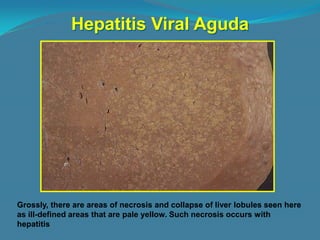 Hepatitis Viral Aguda




Grossly, there are areas of necrosis and collapse of liver lobules seen here
as ill-defined areas that are pale yellow. Such necrosis occurs with
hepatitis
 