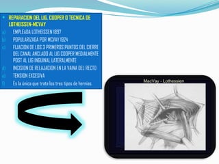Mcvay Incision SEMINARIO HERNIA zzzzzzzzzzzzzzzzzzzzzzzzzzzzzzzzzzz | PPTX