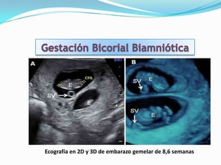 Ecografía en 2D y 3D de embarazo gemelar de 8,6 semanas
 