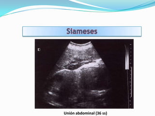 Unión abdominal (36 ss)
 