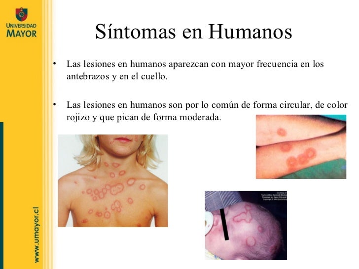 El tratamiento del hongo de las uñas en los pies a los niños por los medios públicos