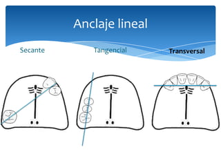Anclaje lineal
Secante Tangencial Transversal
 