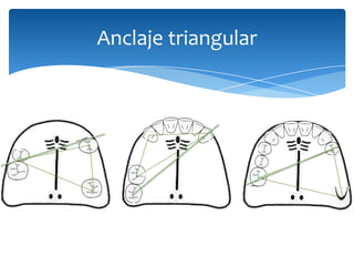 Anclaje triangular
 