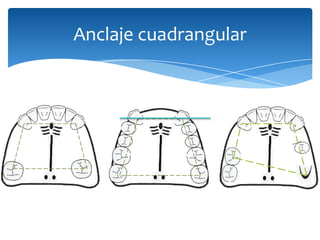 Anclaje cuadrangular
 