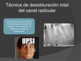 Técnica de desobturación total
del canal radicular
Es la eliminación del relleno
endodóntico del interior del
canal en for...