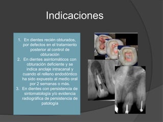 Indicaciones
1. En dientes recién obturados,
por defectos en el tratamiento
posterior al control de
obturación
2. En dient...