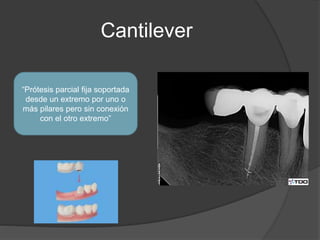 Cantilever
“Prótesis parcial fija soportada
desde un extremo por uno o
más pilares pero sin conexión
con el otro extremo”
 
