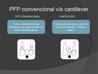 PFP convencional v/s cantilever
Fuerza masticatorias se
distribuyen de manera uniforme
en los dientes pilares
Fuerza aplic...