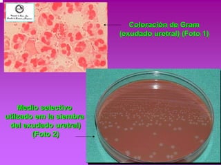Coloración de Gram 
(exudado uretral) (Foto 1) 
Medio selectivo 
utilzado em la siembra 
del exudado uretral) 
(Foto 2) 
 
