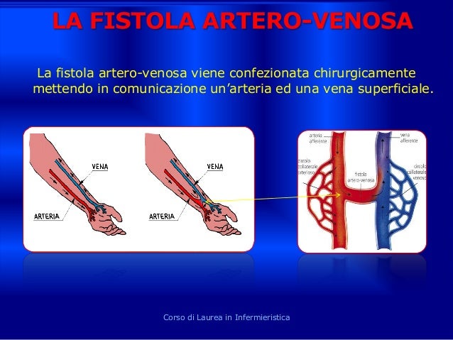 Vene varicose in stadio di subcompenso