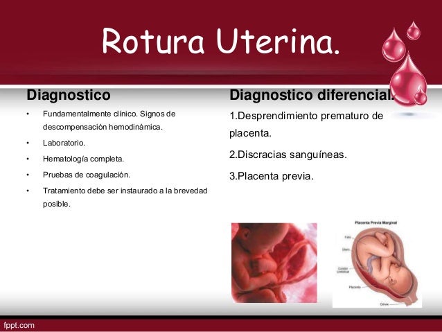 Inminencia De Ruptura Uterina Cie 10