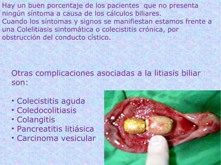 Hay un buen porcentaje de los pacientes que no presenta
ningún síntoma a causa de los cálculos biliares.
Cuando los síntomas y signos se manifiestan estamos frente a
una Colelitiasis sintomática o colecistitis crónica, por
obstrucción del conducto cístico.




  Otras complicaciones asociadas a la litiasis biliar
  son:

  •   Colecistitis aguda
  •   Coledocolitiasis
  •   Colangitis
  •   Pancreatitis litiásica
  •   Carcinoma vesicular
 