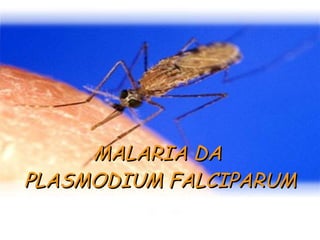 MALARIA DA   PLASMODIUM FALCIPARUM 
