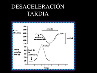 DESACELERACIÓN
    TARDIA
 