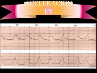 ACELERACION
     ES
 
