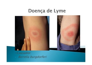 -Causador:
• Borrelia burgdorferi
 