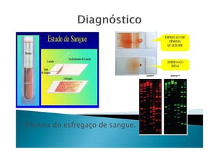 -Técnica do esfregaço de sangue.
 
