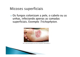 Os fungos colonizam a pele, o cabelo ou as
unhas, infectando apenas as camadas
superficiais. Exemplo Trichophyton.
http://www.lookfordiagnosis.com/mesh_info.php?term=Micoses&lang=3
 