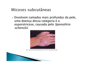 Envolvem camadas mais profundas da pele,
uma doença dessa categoria é a
esporotricose, causada pelo Sponothrix
schenckii.
http://palmaressemdengue.blogspot.com.br/2010/10/esporotricose.html
 