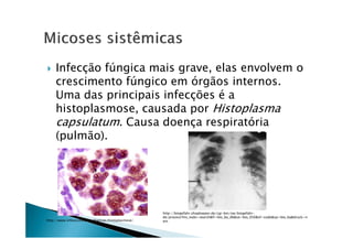 Infecção fúngica mais grave, elas envolvem o
crescimento fúngico em órgãos internos.
Uma das principais infecções é a
histoplasmose, causada por Histoplasma
capsulatum. Causa doença respiratóriacapsulatum. Causa doença respiratória
(pulmão).
http://www.infoescola.com/doencas/histoplasmose/
http://biogefahr.shopkeeper.de/cgi-bin/nw/biogefahr-
de/process?mv_todo=search&fi=bio_ba_db&se=bio_050&sf=code&sp=bio_ba&druck=n
ein
 