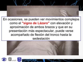 En ocasiones, se pueden ver movimientos complejos
como el "signo de Lázaro" con elevación y
aproximación de ambos brazos y que en su
presentación más espectacular, puede verse
acompañado de flexión del tronco hasta la
sedestación

 